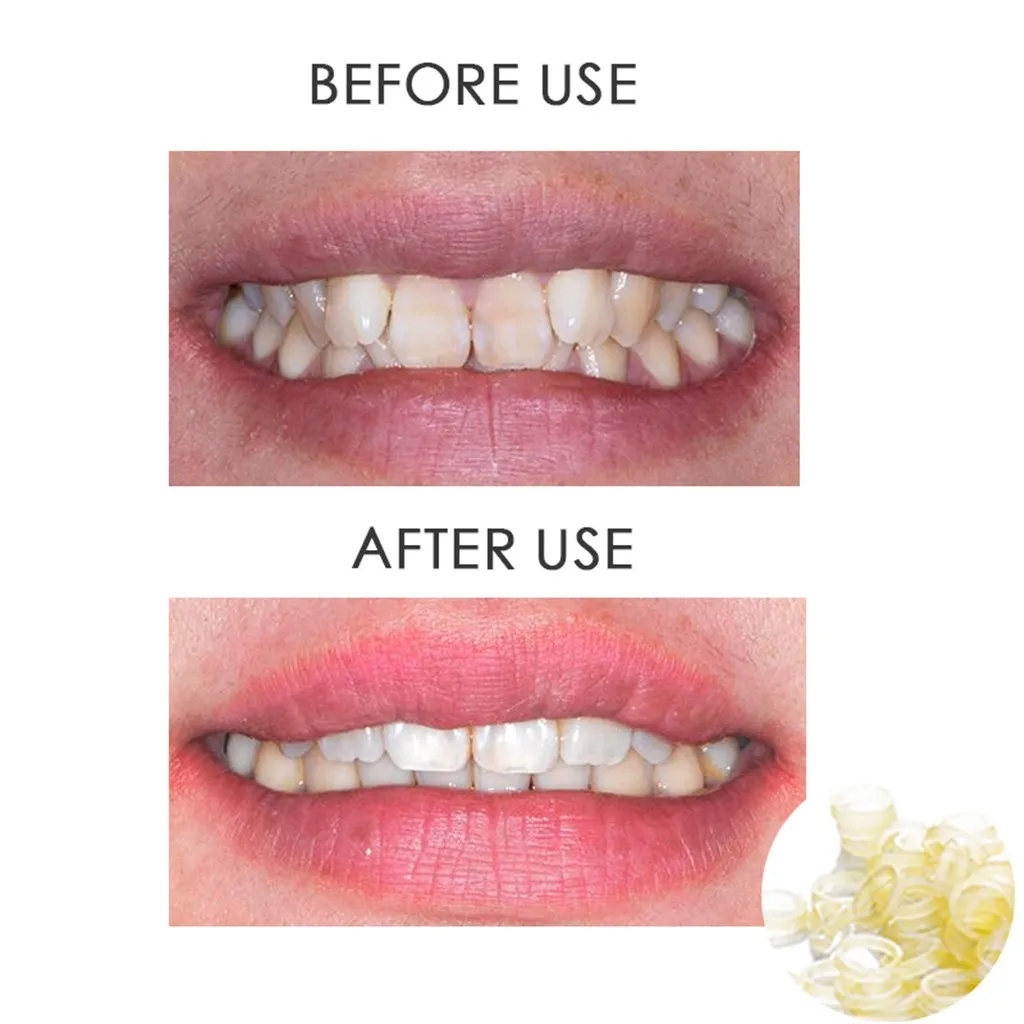 100 шт. стоматологические резинки Ортодонтические скобы для зубов Медицинская