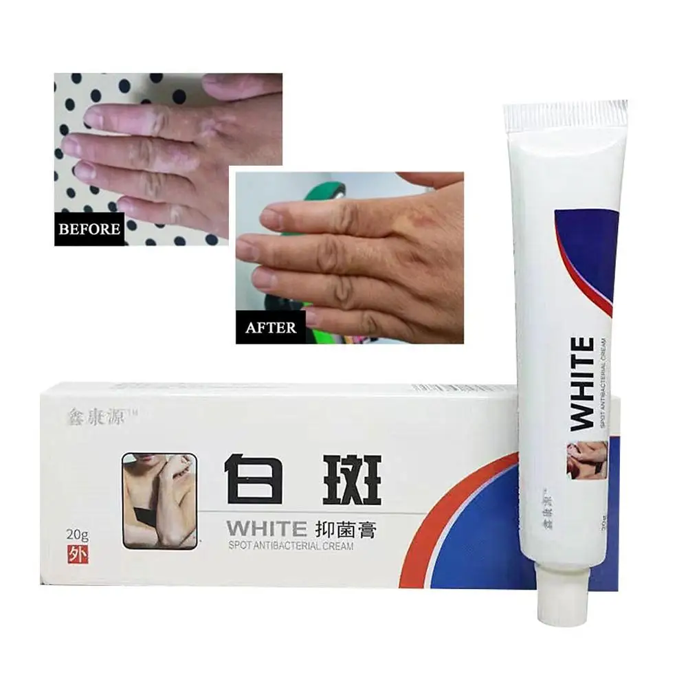 Vitiligo Leukoplakia treatment Cream ointment Chinese Herb Skin Care White Spot Disease Cream Pigment Melanin Promoting Plaster