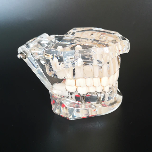 Nowy Model dentystyczny Implant zębów przywrócenie mostu nauczanie studium medycyna nauka choroba dentysta stomatologia produkty 4