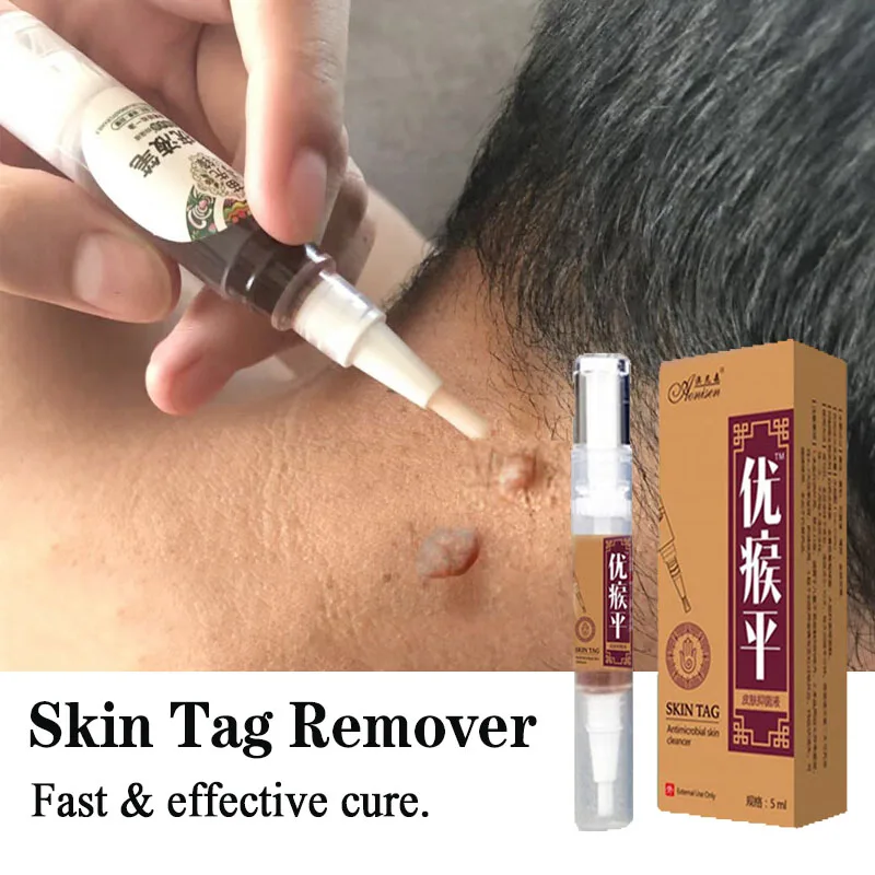 Skin Tag Remover  Against Mole & Genital Wart fast RemovWithin al Anti Foot Corn Removal Warts Papillomas Rapidly removes moles