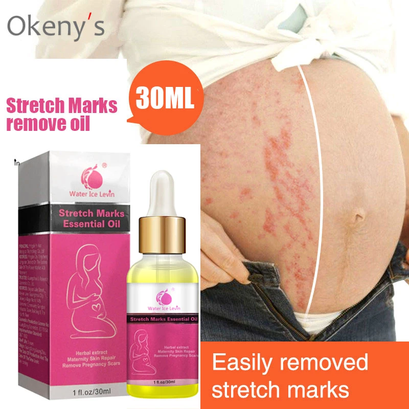 stretch marks remover