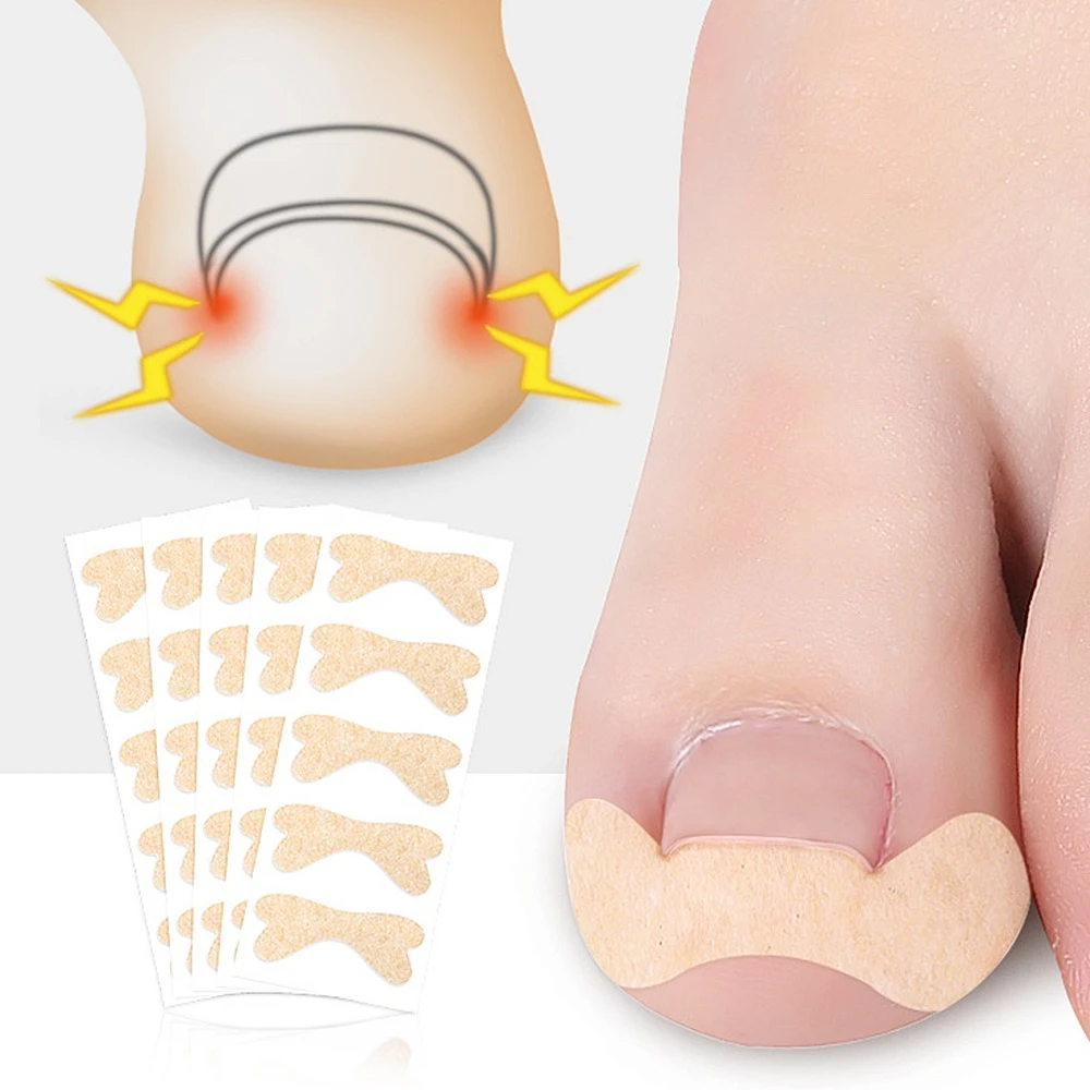  Bunion Corrector Ingrown Toenail Corrector Sticker Paronychia Treatment Fixer Recover bunion Pedicure Foot Toe Nail Care Tool 