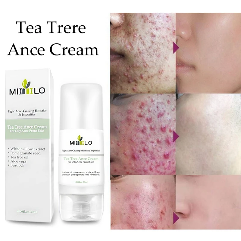 

Plant Essence Tea Tree Acne Treatment Cream Moisturizing Nourishing Skin Oil-Control Anti-acne Cream