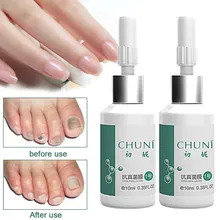 20 мл клей для ремонта ногтей отвердевающий пилинг ускоритель роста противогрибковое лечение рингчервь Leuconychia восстановление релюстеризации портативный
