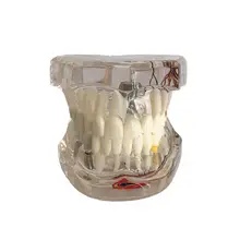 Стоматологическая модель имплантата зубов с реставрационным мостом зубной Стоматолог для медицинских исследований