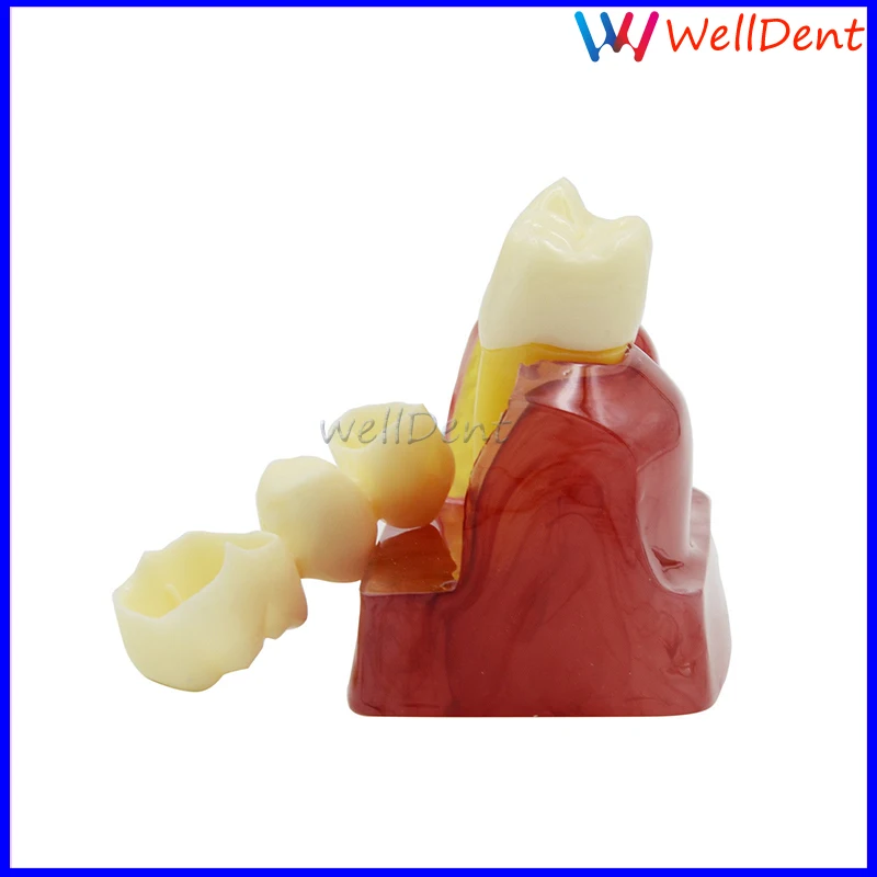 1-Macro-Implant-Model-Crown-Bridge-Demostratation-Teeth-_57