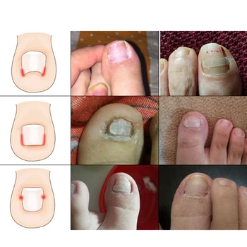 

Ingrown Toe Nail Correction Sticker Patch Paronychia Correction File Foot Care Tool Wire Corrector Yellow