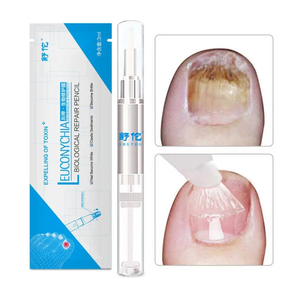 

3ml Fungal Nail Pen Effective Onychomycosis Paronychia Fungus Infection Repair Solution Gel Toenail Treatment Nutrient Essence