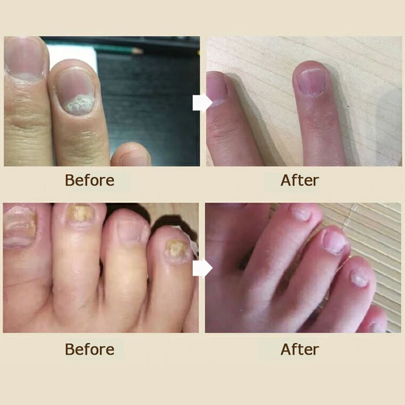 кандидозный онихомикоз. ногти на исследование грибка. иссечение ногтевой пластины лазером. гиперкератотический онихомикоз. онихолитический онихомикоз.