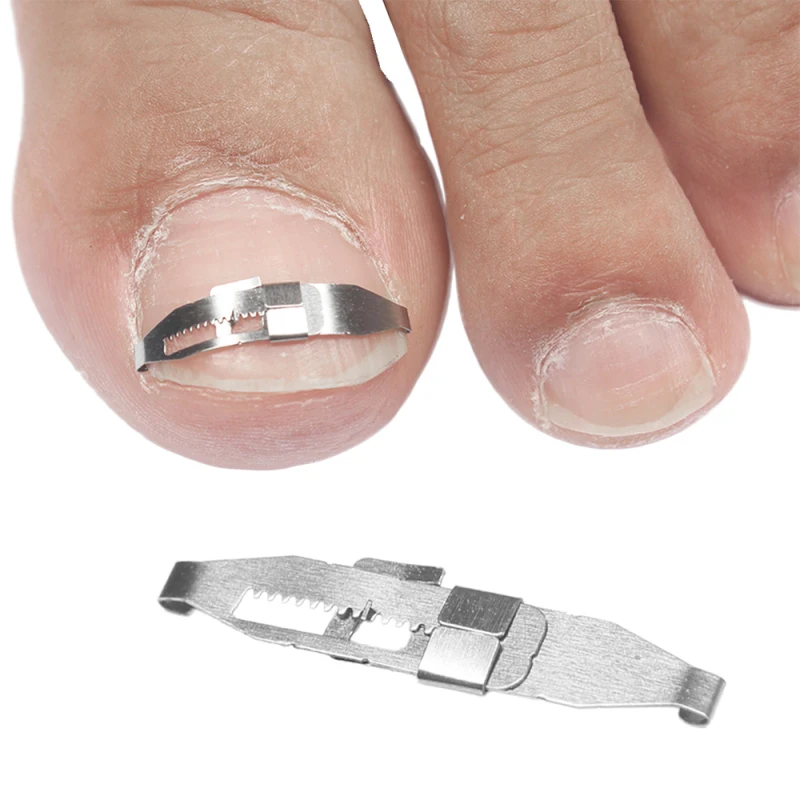 Скоба 3то корректирующая. Скобы на ногти для выпрямления. Ортониксия скоба пластина титановая нить. Скобы на палец ноги. Пластина для вросшего ногтя на ноге.