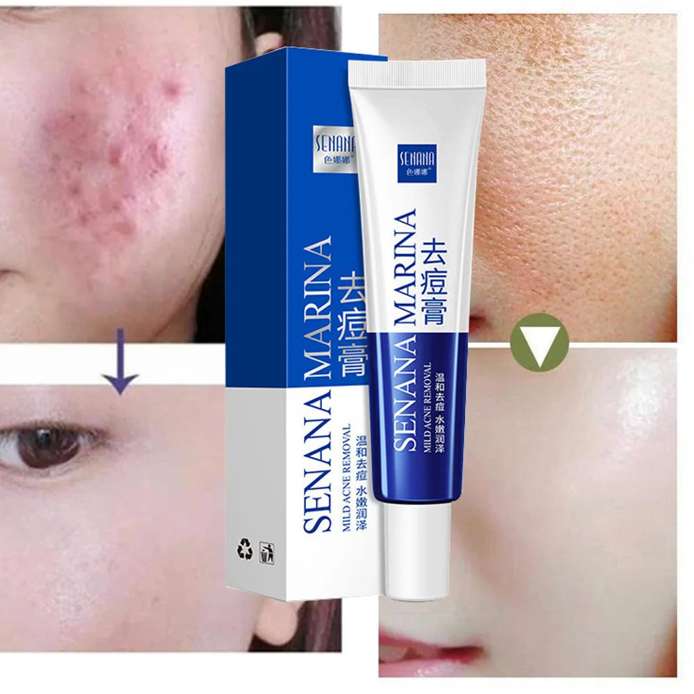 Okeny's Anti Acne Pimple Cream Repair Scars Inflammatory Face Beauty Smooth Skin Care Oil Control Vera Aloe Gel | Красота и