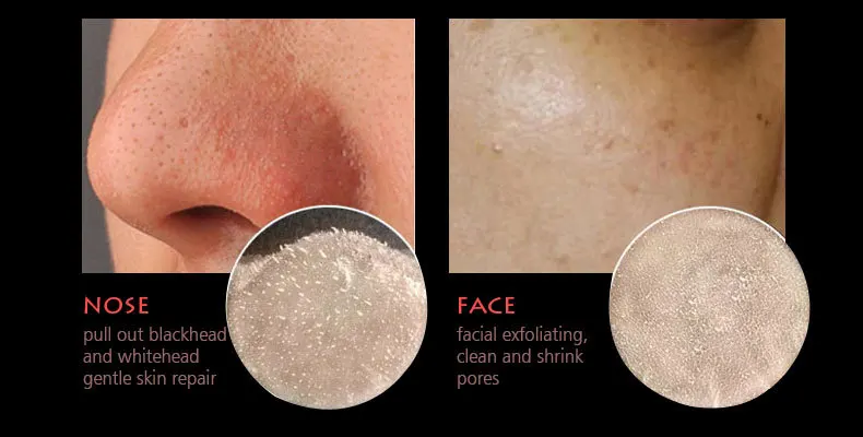 rose-blackhead-removal_08