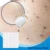 108pcs Skin Tag Remover Warts Remover Patch Wart Treatment Cream Herbal Extract Foot Corn Plaster Acne Warts Sticker