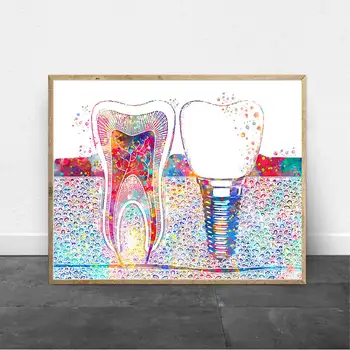 

Dental Art Picture Tooth Implant Canvas Print Dentist Wall Art Painting Medicine Hygienist Poster Tooth Water color Clinic Decor