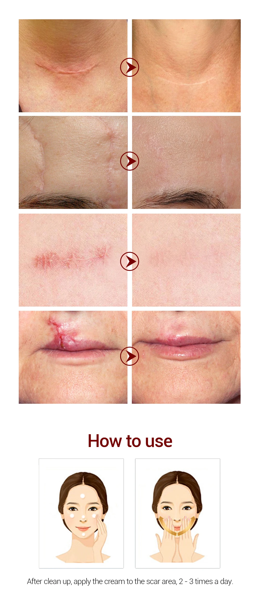 蓝贝那去疤霜_06