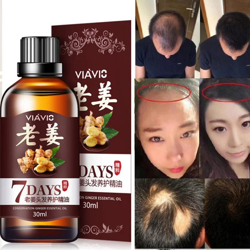 Aceite de jengibre mágico para el crecimiento del cabello, herramienta de esencia para el cuidado del cabello, tratamiento antipérdida, 30ml