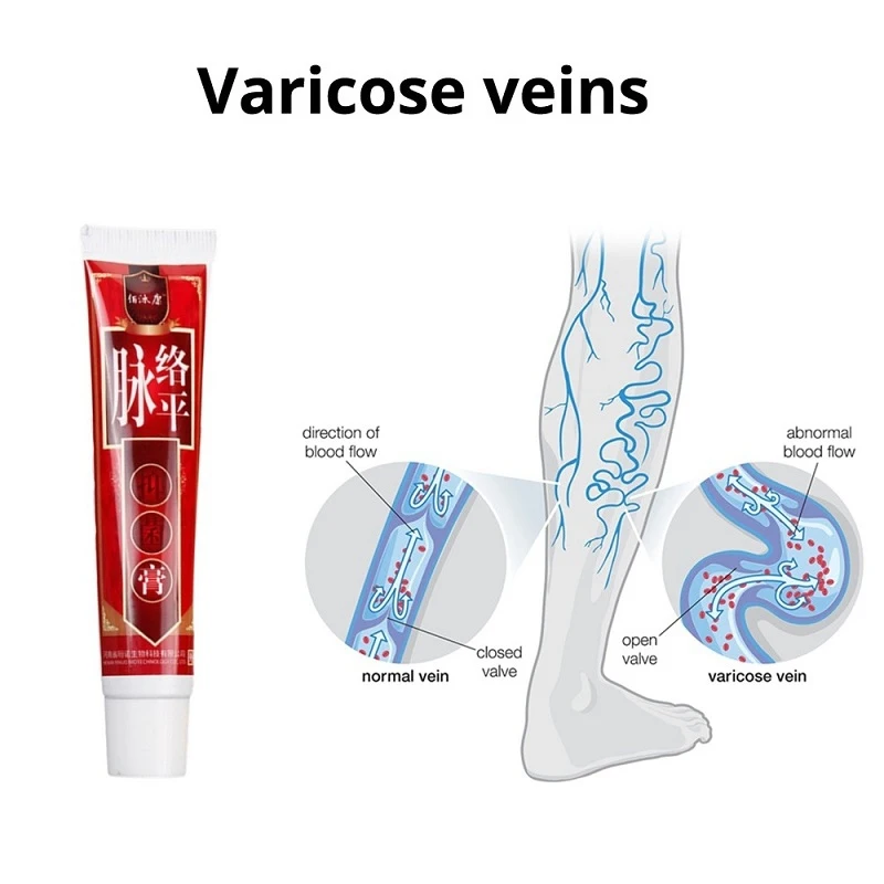 

Ointment Vasculitis Phlebitis Spider Varicosity Angiitis Removal Herbal Cream Varicose Veins Treatment Body Cream