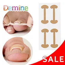 Ongle incarné correcteur autocollants Paronychia traitement récupérer correcteur pédicure outils ongle orteil soin des ongles(China)