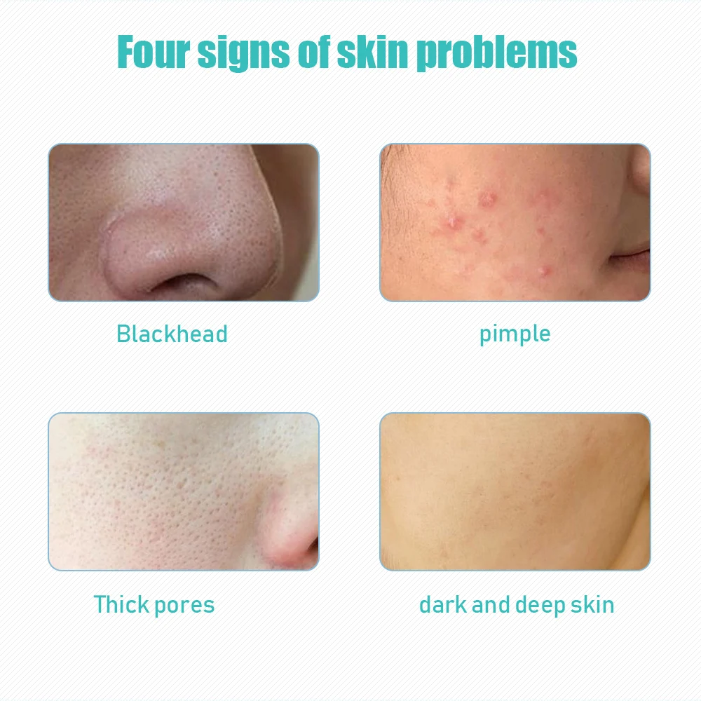 Aspirador de pó Cuidados com a Pele Pequena Bolha Limpeza Facial Whitehead Blackhead Ance Removedor Psiquiatra Poros Hidratante Rosto Peeling Dispositivo Mod. 1210908 19 rosto cuidados com a pele peeling dispositivo
