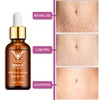 Stretch Marks Remover Essential Oil Eliminate Pregnancy Scars Maternity Repair Anti Winkle Skin Firming Treatment ► Photo 3/6