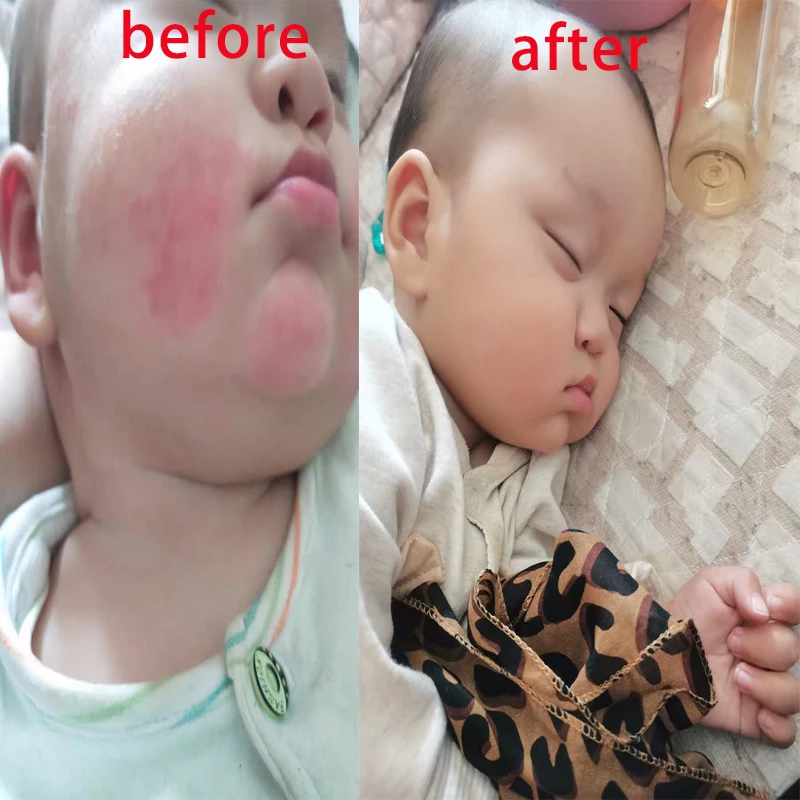 Медицинская штукатурка детский холодный компресс гель Eczema крем красный пердеж