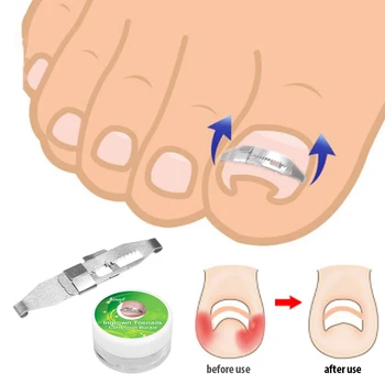 

Ingrown Toenail Corrector Toenail Correction Treatment Tool Foot Nail Care Tool Orthotic Nail Corrector Pedicure Tool