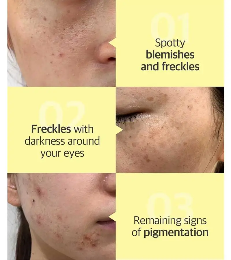 Alguns por mi Manchas de Acne mi de Clareamento Yuja Niacina Cuidado Soro 50ml Ina Essência Poderoso Sarda Creme Remover Melasma Ble mi sh 4 sh cuidado soro 50ml ina ina mi