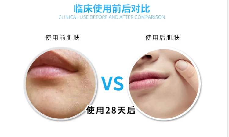 Repair factor essence oligopeptide essence fade acne marks