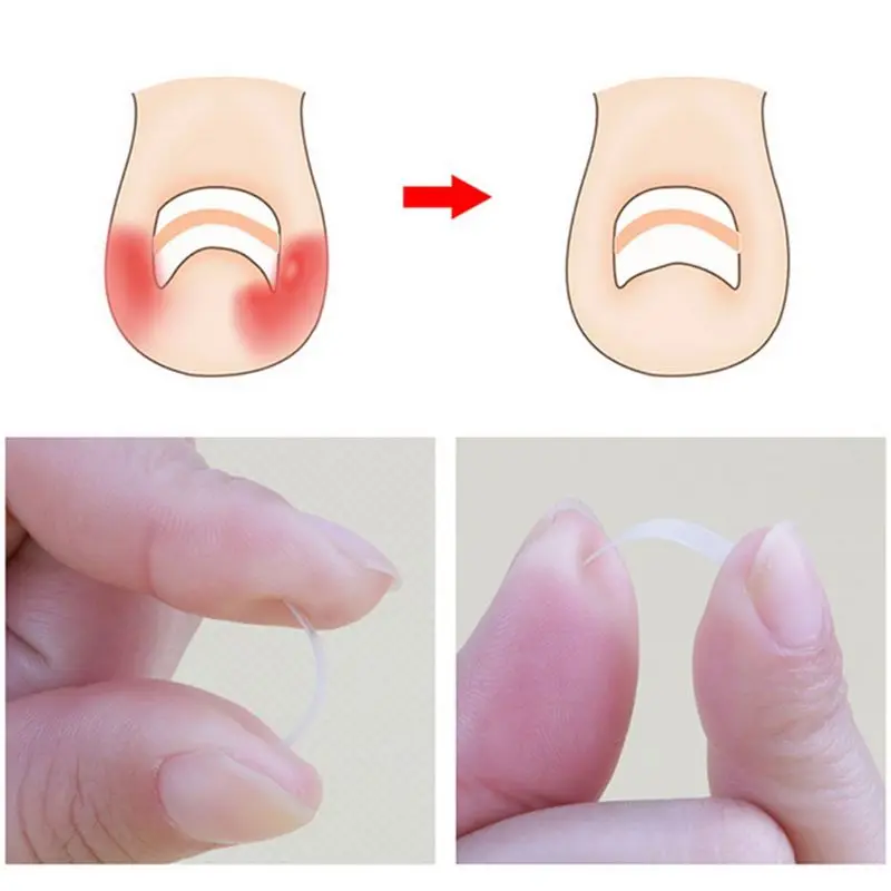 

Special Glue+12Pcs Ingrown Toe Foot Nail Correction Sticker Toenail Corrector