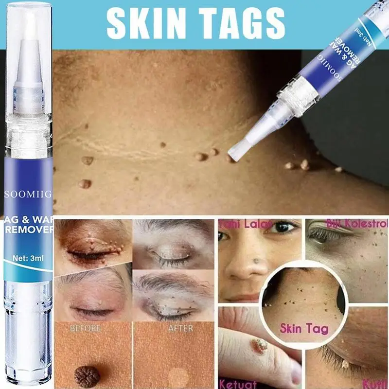 Skin Tag Remover Pen Natural Health Mole Wart Skin Corn Foot Tag Liquid Treatment Skin Care Warts Tag Removal Herbal Extract