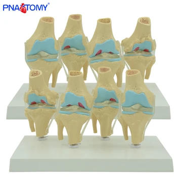 

Four sets human knee model normal and abnormal knee joints model medical teaching tool skeleton anatomy