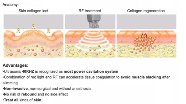 Bipolar RF+tripolar RF+vacuum, cavitation rf vacuum slimming machine with CE