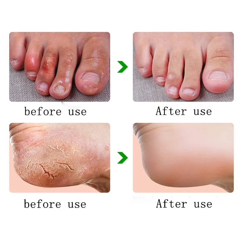 Recommend Foot cream for cracked heels Anti Crack cream skin care Chinese Ointment Anti chapping