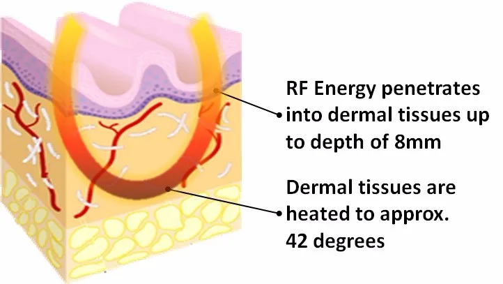 rf-skin-tightening-during