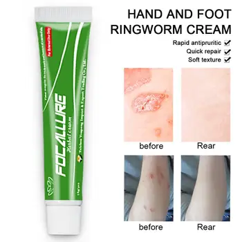 

Eczema Cream Skin Psoriasis Cream Dermatitis Eczematoid Eczema Ointment Treatment Psoriasis Cream Skin Care Cream body cream