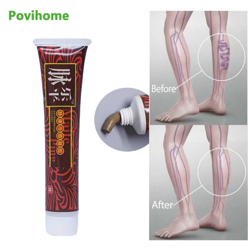1Pcs Varicose Veins Ointment Treatment Varicosity Angiitis Removal Medical Plaster Relief Vasculitis Phlebitis Spider Cream |