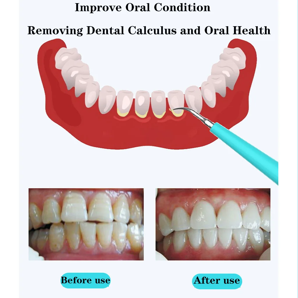 Электрический звуковой отбеливание зубов 3 режима стоматологический USB портативный скалер Ультра звуковой оральный от зубных пятен зубной камень Calculus инструмент для удаления