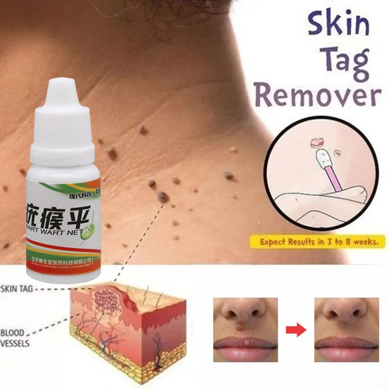 

Chinese Medicine Treatment Foot Corn Removal Plantar Warts 12 Hours Tu Kill Liquid Remover Body Black Dots Mole Wart Skin Tag