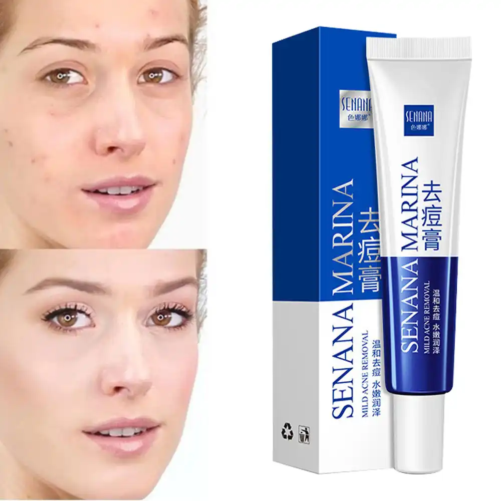 anti inflammatory cream for pimples