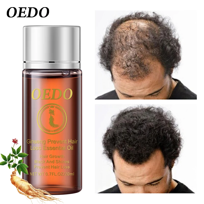 OEDO 2pcs/lot hair fast growing essence for bald essential oil treatment, preventing hair loss, effectively treating dry hair OEDO 2pcs/lot hair fast growing essence for bald essential oil treatment, preventing hair loss, effectively treating dry hair