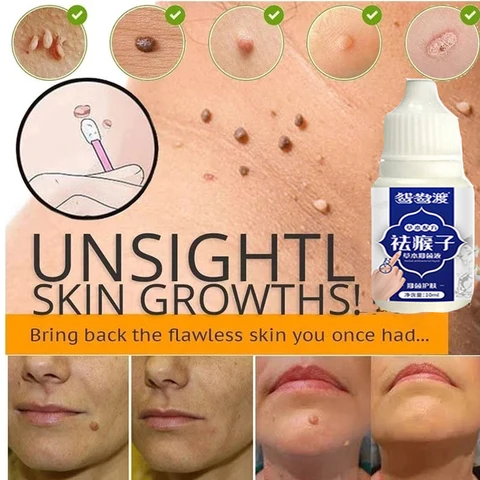 Bacteriostatic Liquid 10ML Skin Tag Remover Genital Wart Treatment Instant Removal Mole&Papillomas Foot Corn Repair Tool