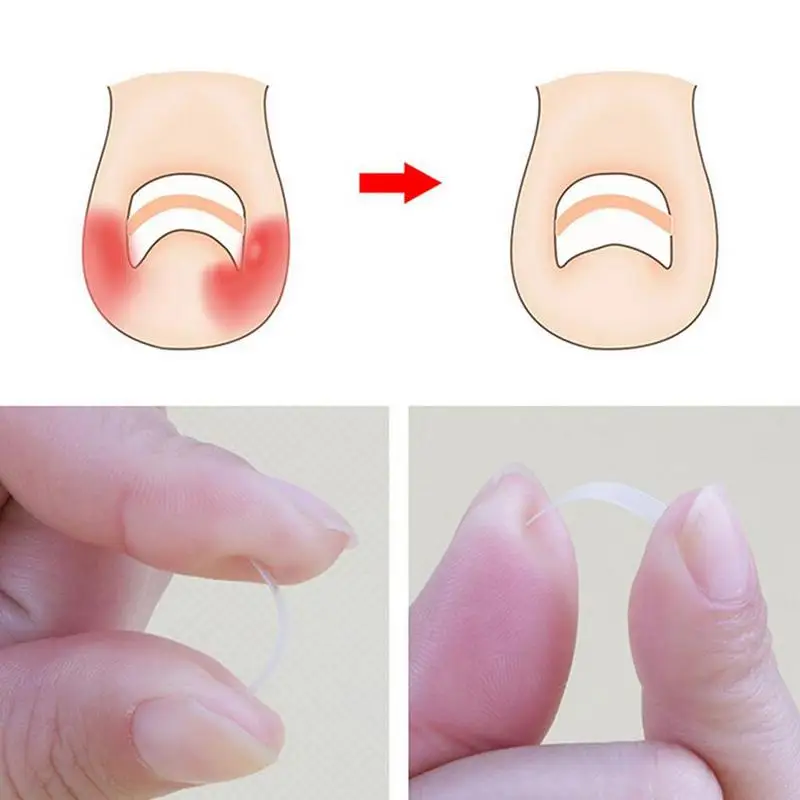 Ingrown Toenail Correction Tool Set Ingrown Toe Nail Clip Foot Straightening Care Brace Elastic Pedicure Patch Corrector Bu P4N7