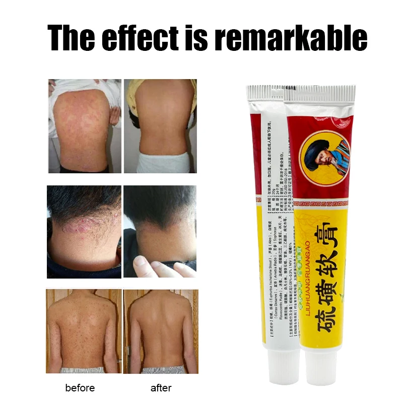 

Sulfur Ointment Natural Herbal Skin Psoriasis Cream No Side Effects Eczema Ointment Dermatitis Eczematoid Balm