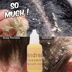 Natural Anti Dandruff Essential Oils Fast Get Rid of Anti Dandruff  Hair Loss Scalp Cleaning Dandruff Repair Health Care