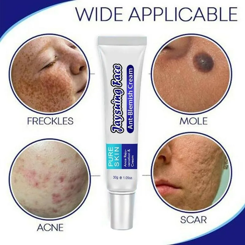 topical cream for pimples