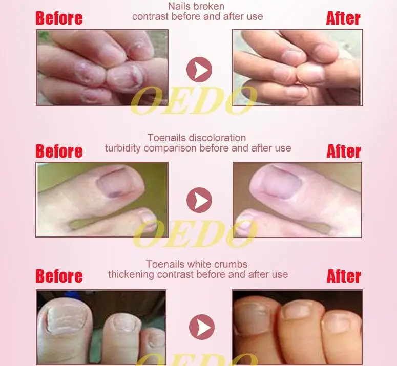 OEDO Nail Treatment Essential oil Hand and Foot Onychomycosis Toe Nail Fungus Removal Infection Feet Care 30ml OEDO Nail Treatment Essential oil Hand and Foot Onychomycosis Toe Nail Fungus Removal Infection Feet Care 30ml