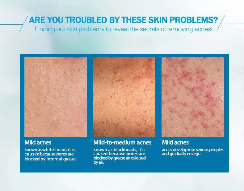 anti-acne_05