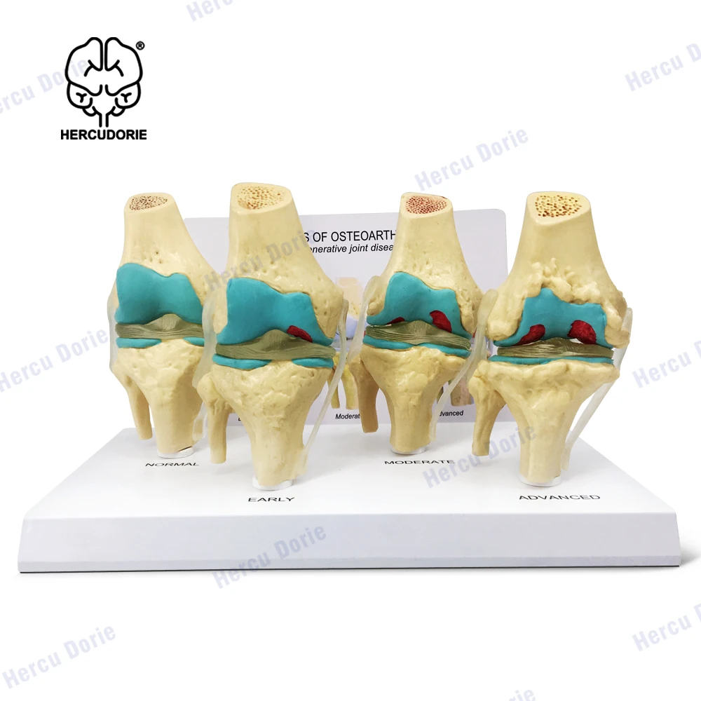 

Knee Joint Model Set | Human Body Anatomy Replica Set of 4-Stage Osteoarthritis Knee Joint for Doctors Office Educational Tool
