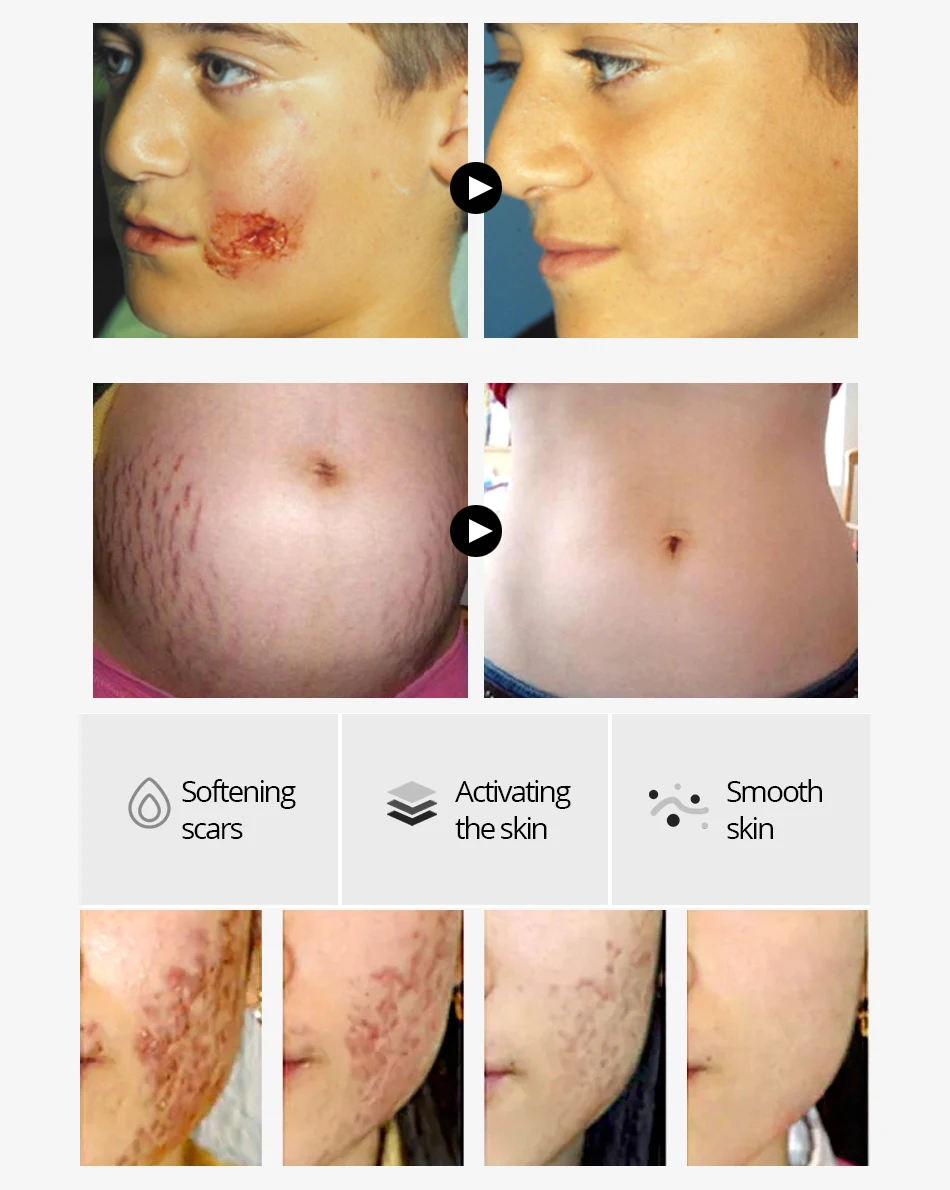 VIBRANT GLAMOUR Crocodile Dispel Scar Repair Face Serum Remove Stretch Marks Acne Scar Treatment Skin Lightening Whitening Care