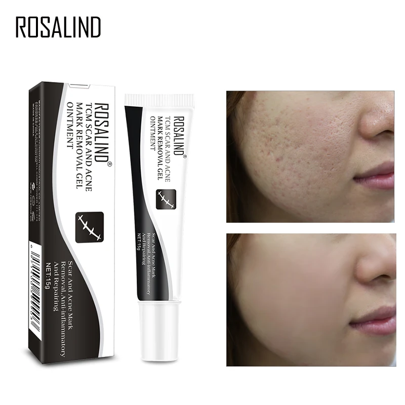 ROSALIND Acne Scar Treatment Face Cream Stretch Mark Remover Acne Pimple Spot Repairing Scar From Acne Skin Care Whitening Cream